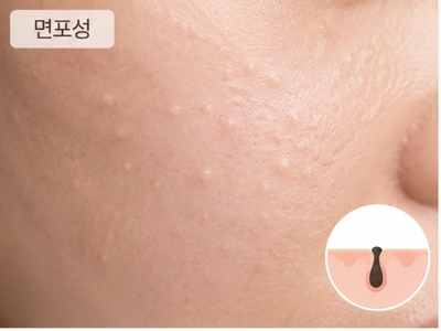 면포성 여드름