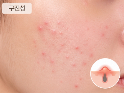 구진성 여드름