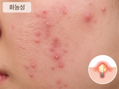 농포성 여드름