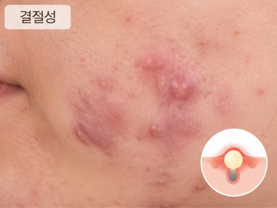 결절낭종형